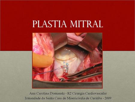Plastia Mitral Ana Carolina Domanski - R2 Cirurgia Cardiovascular Irmandade da Santa Casa de Misericórdia de Curitiba - 2009.