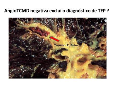 AngioTCMD negativa exclui o diagnóstico de TEP ?