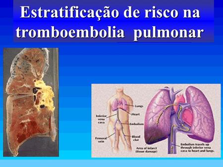 Estratificação de risco na tromboembolia pulmonar