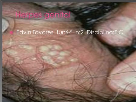 Herpes genital Edvin Tavares tur:6-º n:2 Disciplina:F.C.