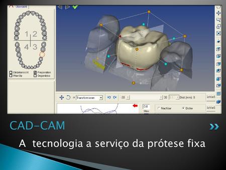 CAD-CAM A tecnologia a serviço da prótese fixa.