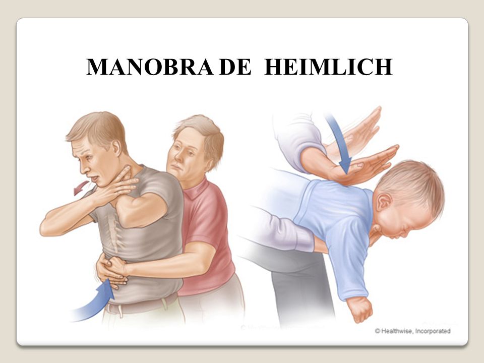 MANOBRA DE HEIMLICH