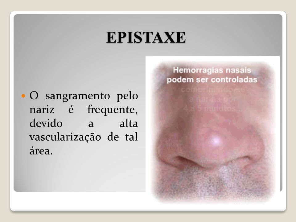 EPISTAXE O sangramento pelo nariz é frequente, devido a alta vascularização de tal área.