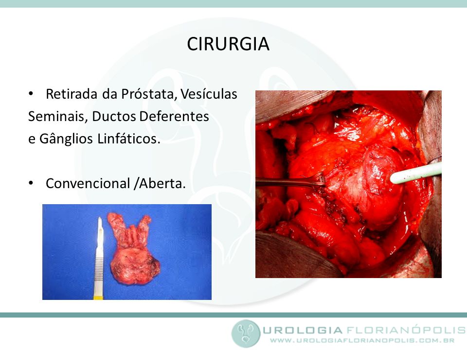 CIRURGIA Retirada da Próstata, Vesículas Seminais, Ductos Deferentes