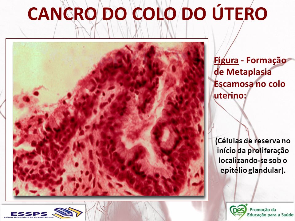 CANCRO DO COLO DO ÚTERO Figura - Formação de Metaplasia Escamosa no colo uterino:
