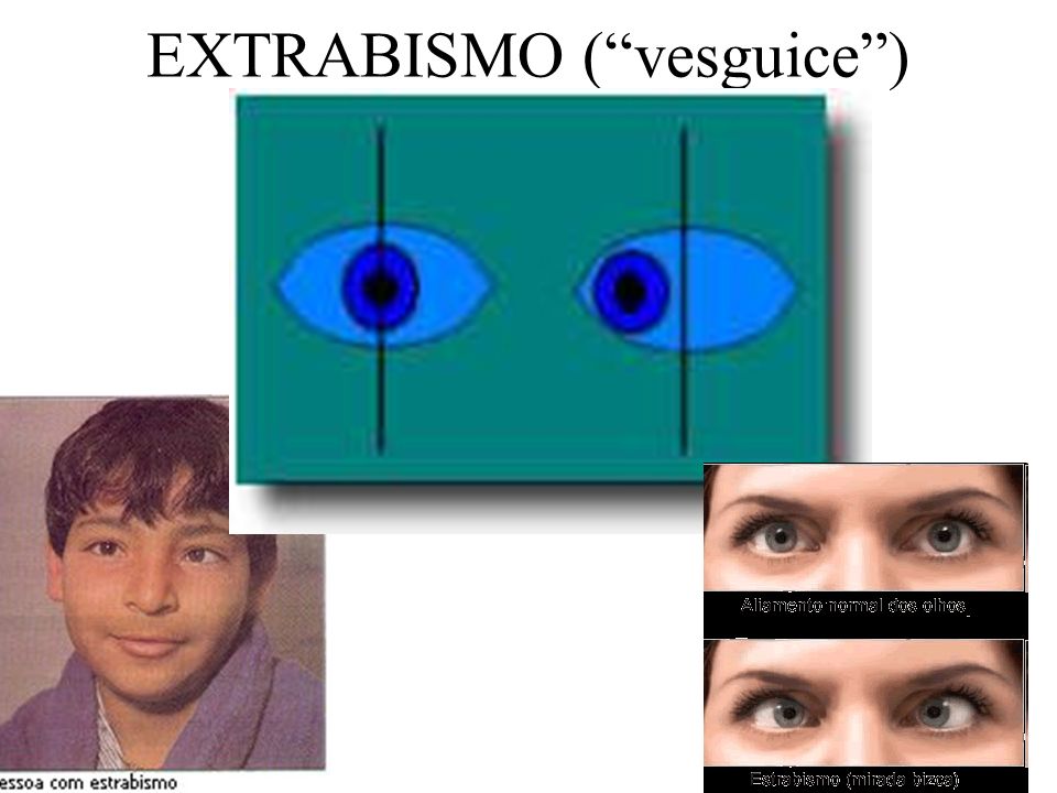 EXTRABISMO ( vesguice )