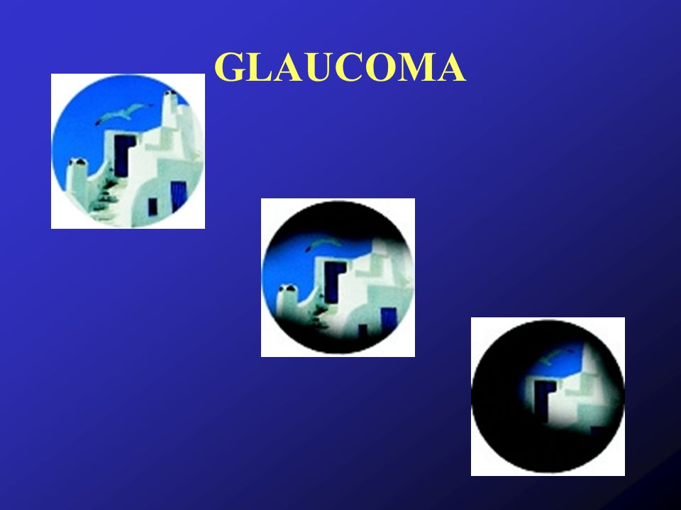 GLAUCOMA