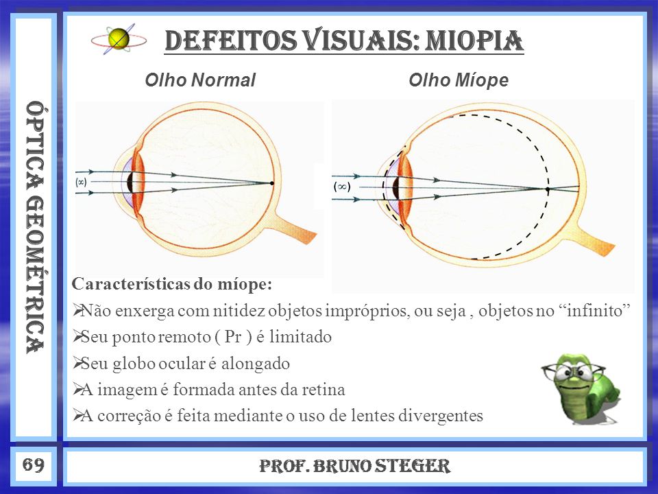 DEFEITOS VISUAIS: Miopia
