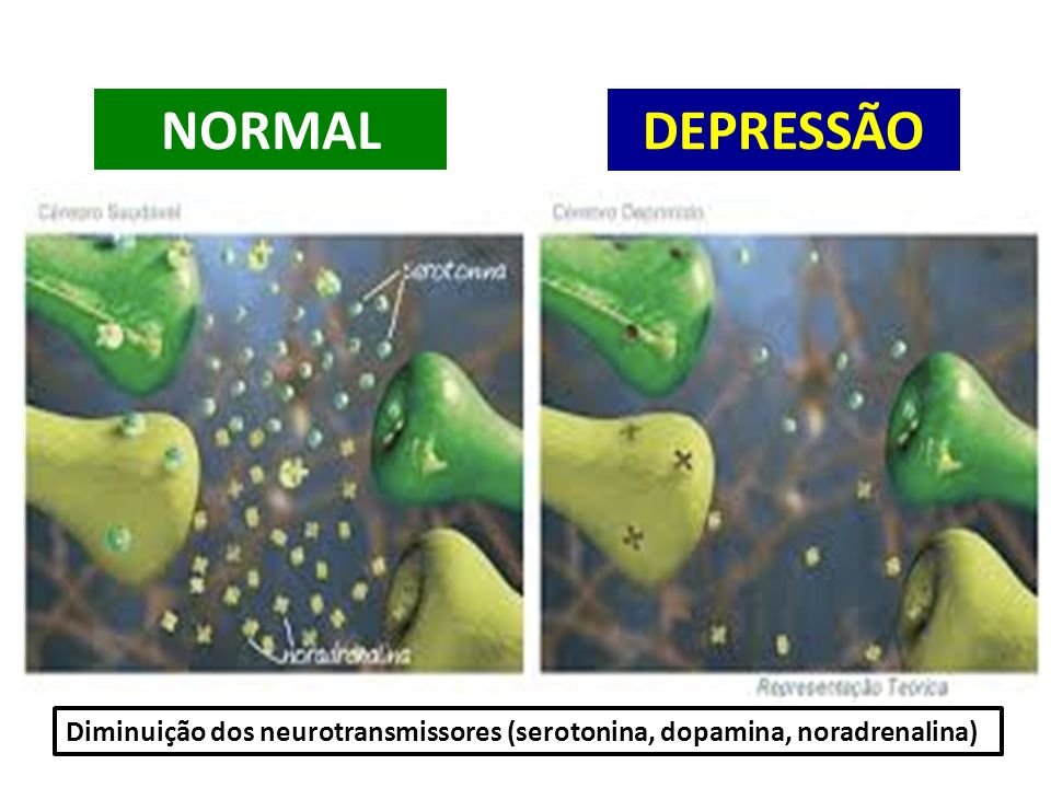 NORMAL DEPRESSÃO Diminuição dos neurotransmissores (serotonina, dopamina, noradrenalina)