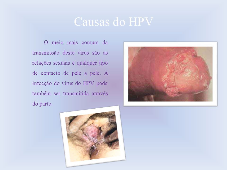 Causas do HPV