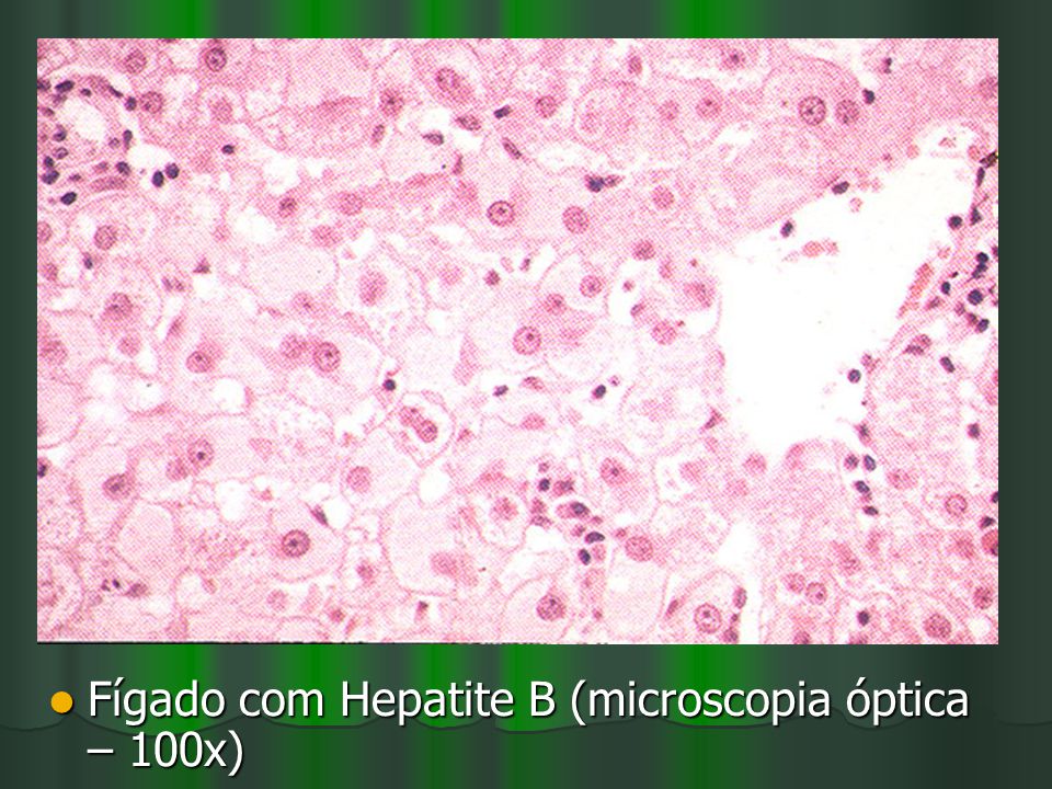 Fígado com Hepatite B (microscopia óptica – 100x)