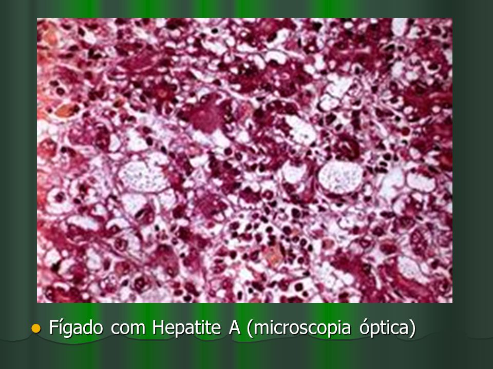 Fígado com Hepatite A (microscopia óptica)