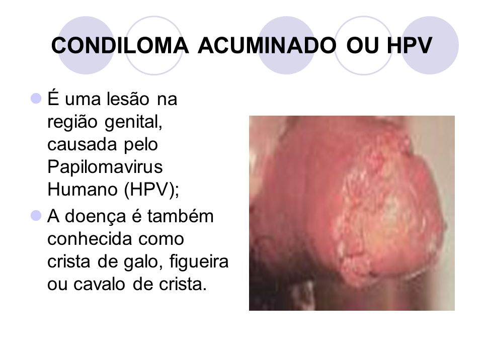 CONDILOMA ACUMINADO OU HPV