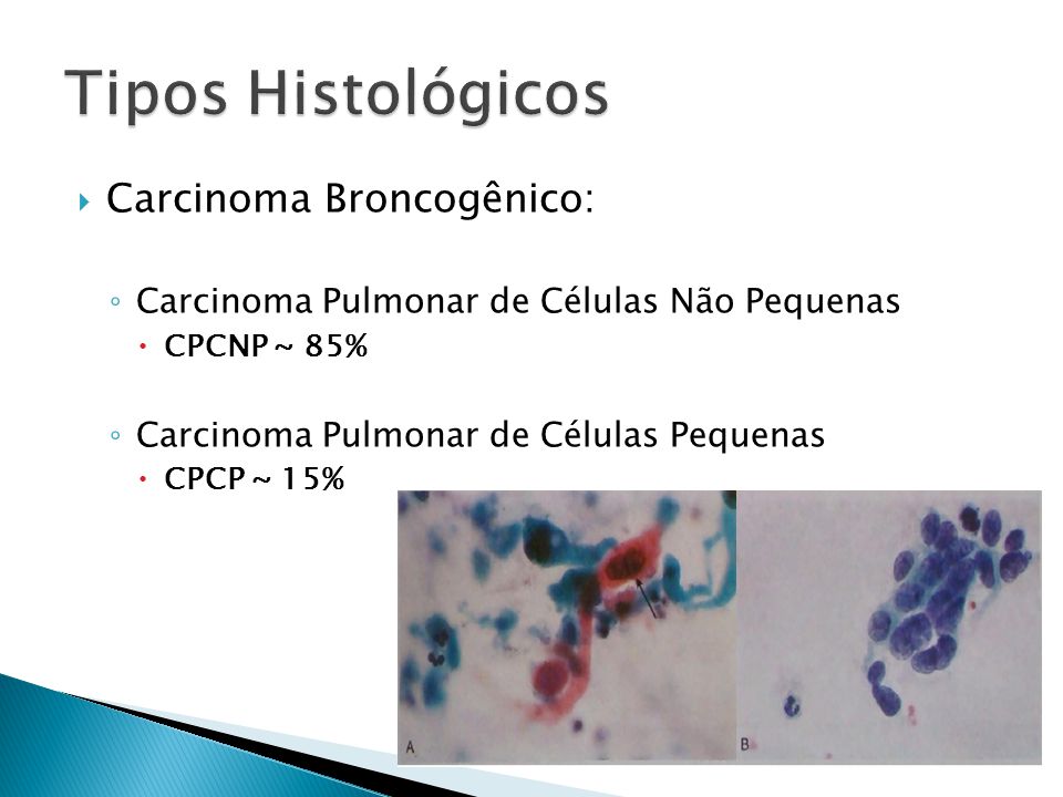 Tipos Histológicos Carcinoma Broncogênico: