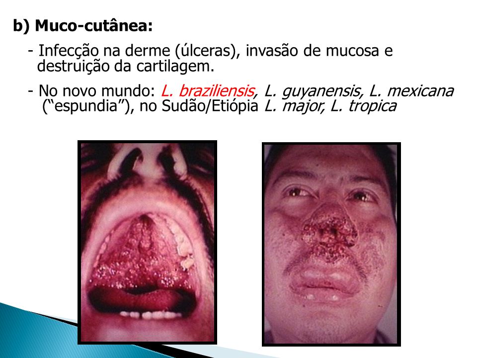 b) Muco-cutânea: - Infecção na derme (úlceras), invasão de mucosa e destruição da cartilagem.