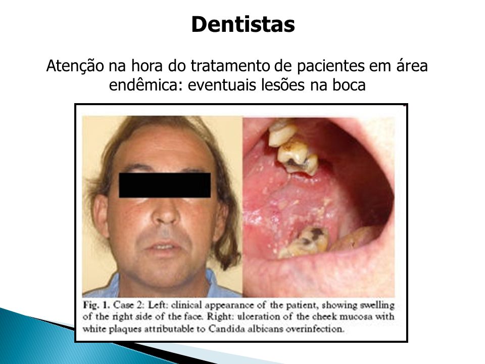 Dentistas Atenção na hora do tratamento de pacientes em área endêmica: eventuais lesões na boca