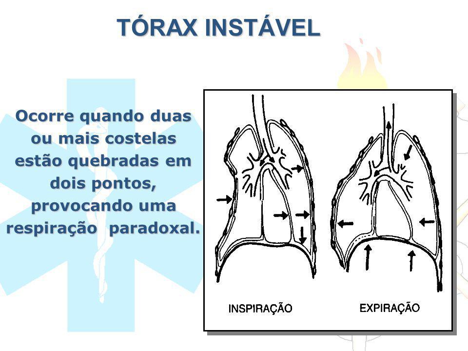 TÓRAX INSTÁVEL Ocorre quando duas ou mais costelas estão quebradas em dois pontos, provocando uma respiração paradoxal.