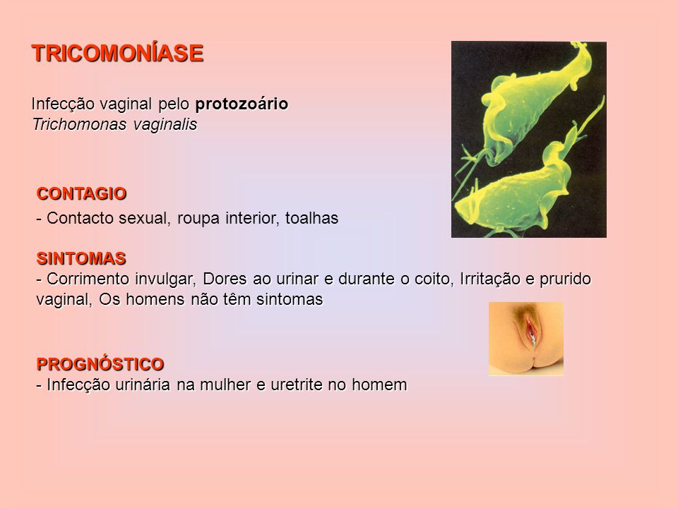 TRICOMONÍASE Infecção vaginal pelo protozoário Trichomonas vaginalis