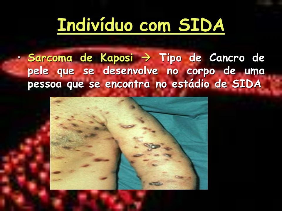 Indivíduo com SIDA Sarcoma de Kaposi  Tipo de Cancro de pele que se desenvolve no corpo de uma pessoa que se encontra no estádio de SIDA.