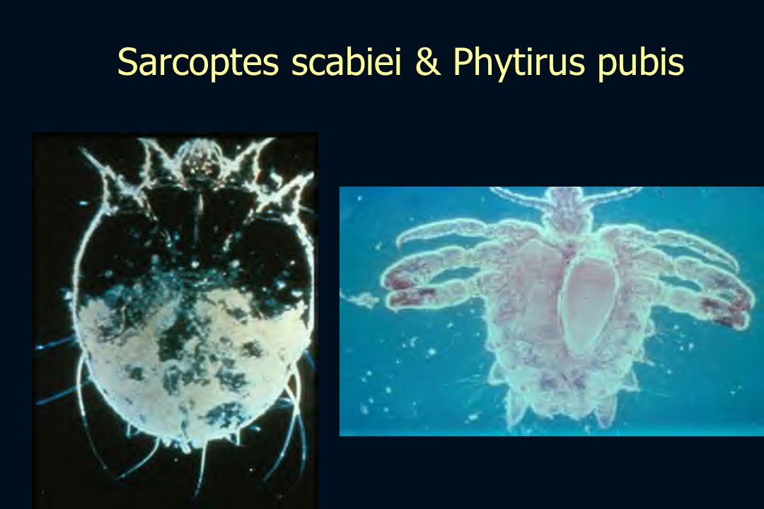 Sarcoptes scabiei & Phytirus pubis