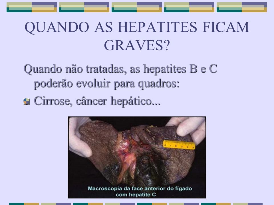 QUANDO AS HEPATITES FICAM GRAVES