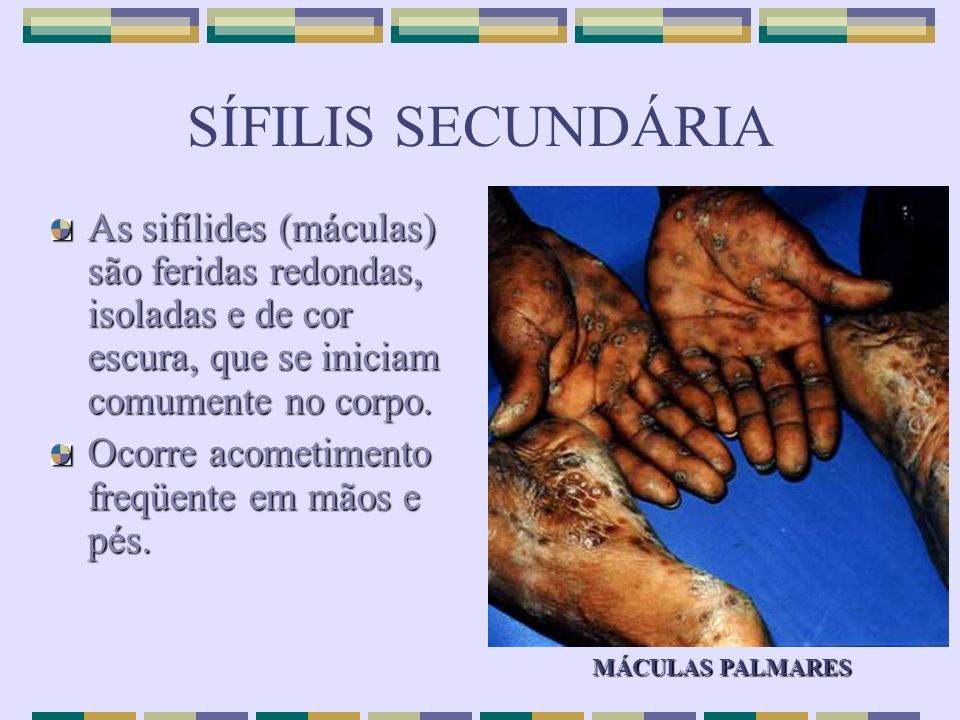 SÍFILIS SECUNDÁRIA As sifílides (máculas) são feridas redondas, isoladas e de cor escura, que se iniciam comumente no corpo.