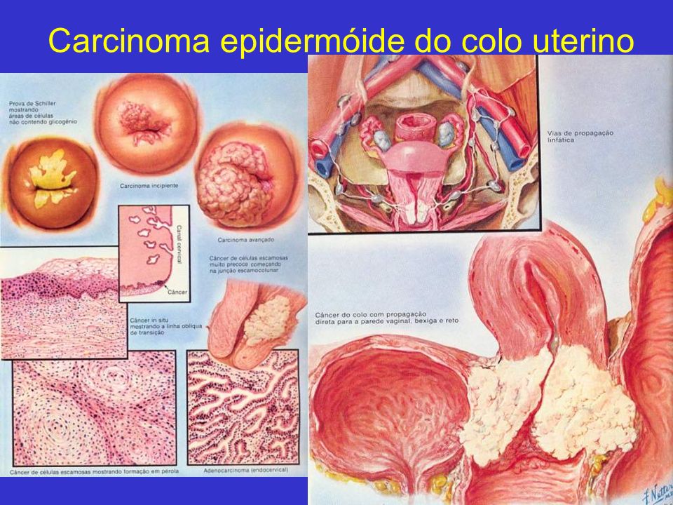 Carcinoma epidermóide do colo uterino