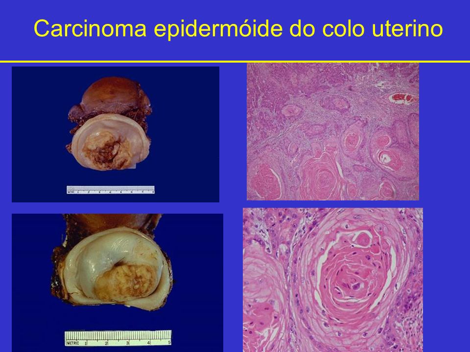 Carcinoma epidermóide do colo uterino
