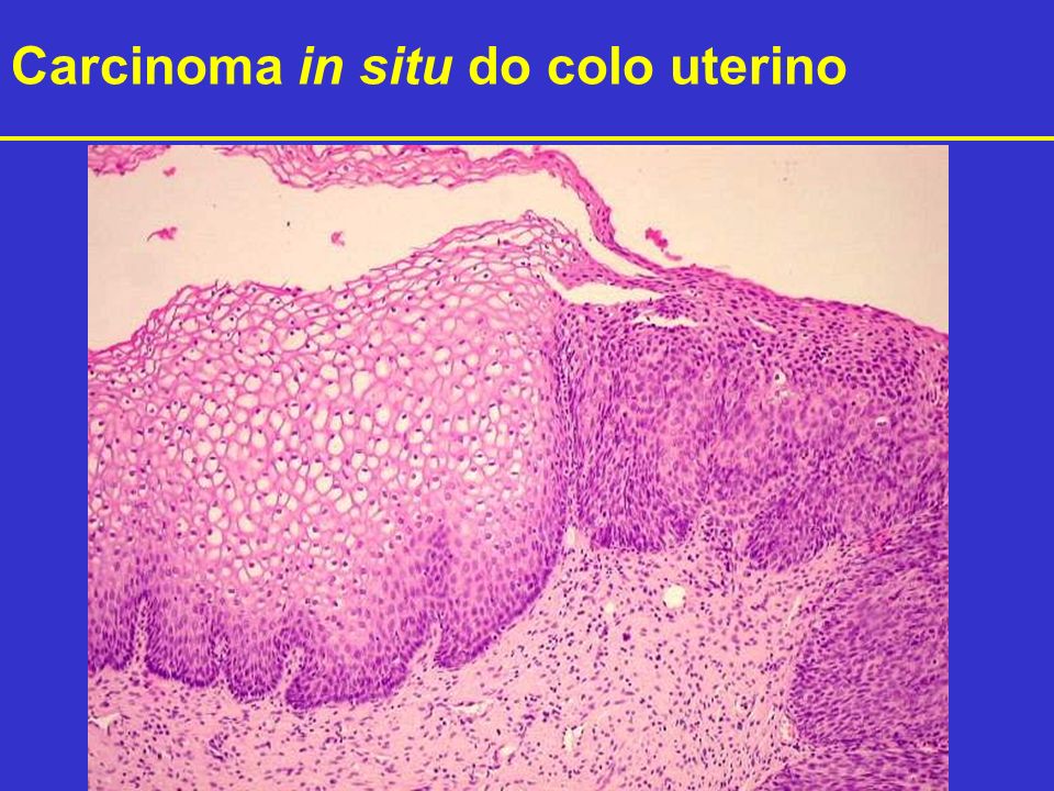 Carcinoma in situ do colo uterino
