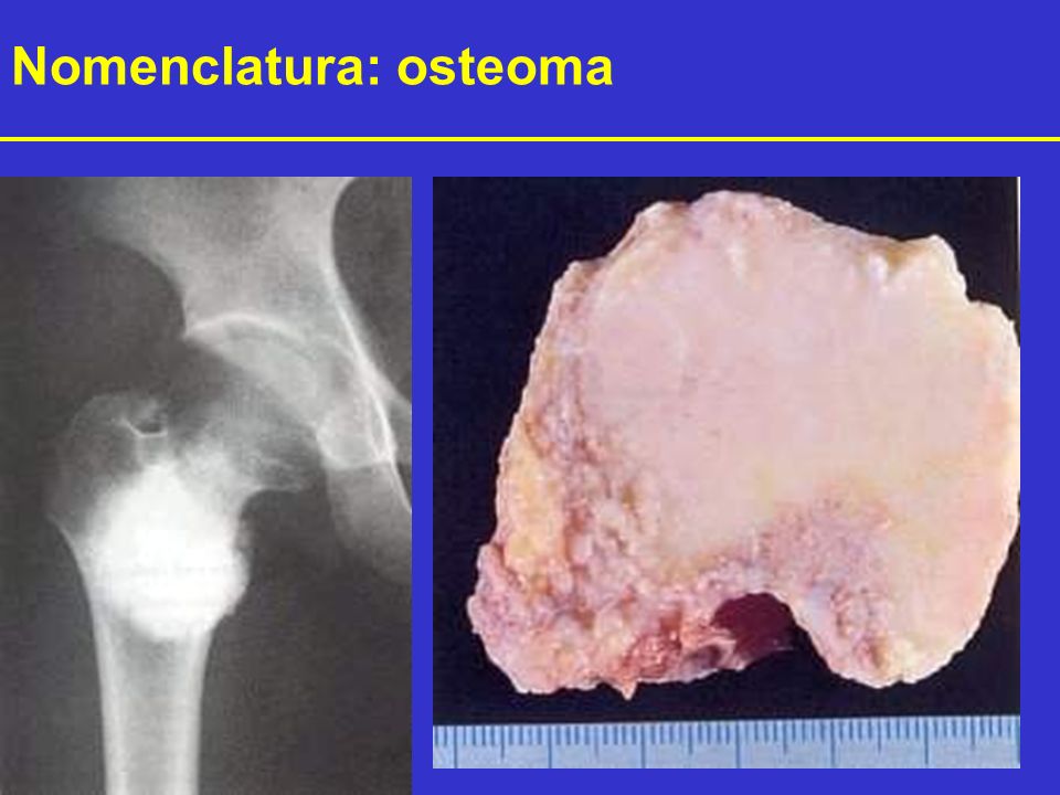 Nomenclatura: osteoma