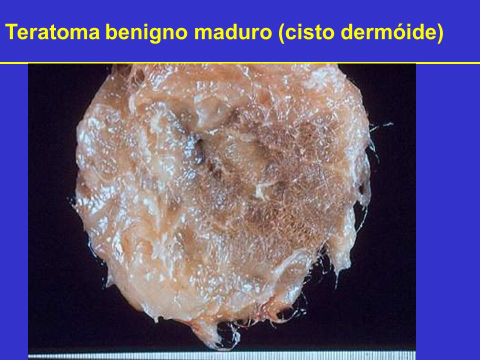 Teratoma benigno maduro (cisto dermóide)