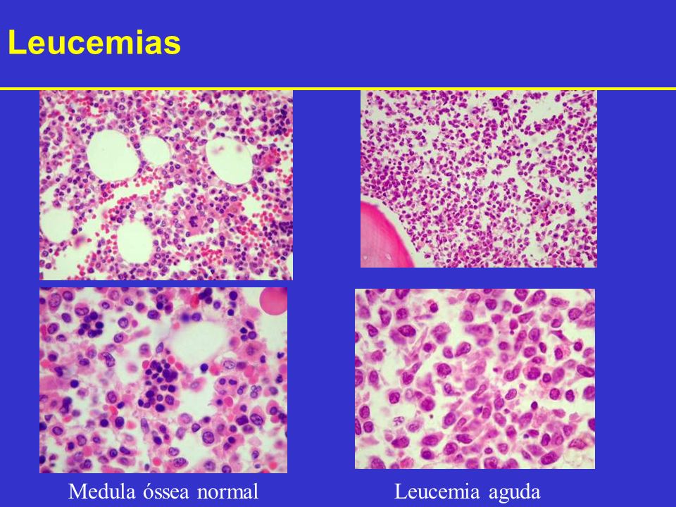 Leucemias Medula óssea normal Leucemia aguda