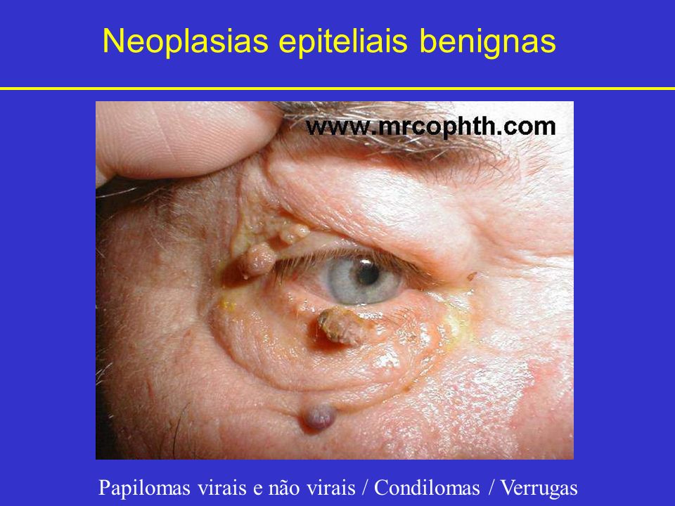 Neoplasias epiteliais benignas