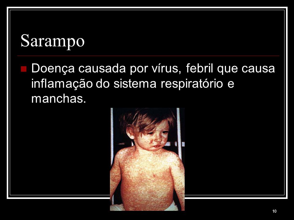 Sarampo Doença causada por vírus, febril que causa inflamação do sistema respiratório e manchas.