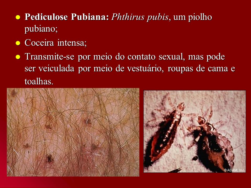 Pediculose Pubiana: Phthirus pubis, um piolho pubiano;