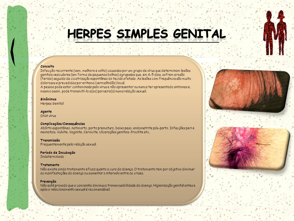 Herpes Simples Genital