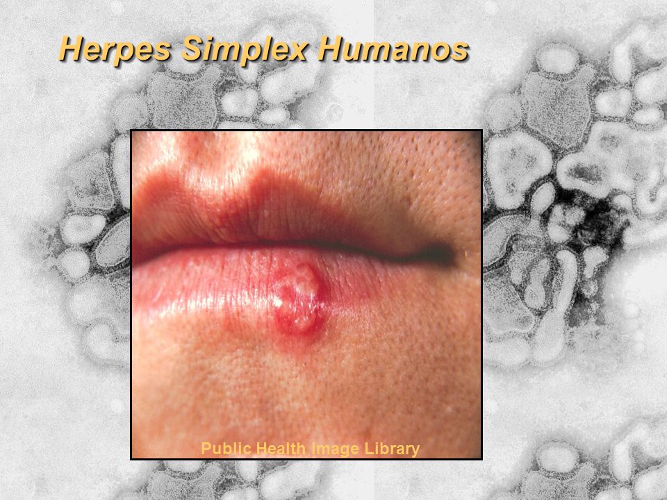 Herpes Simplex Humanos