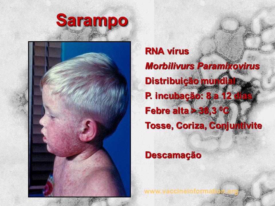 Sarampo RNA vírus Morbilivurs Paramixovirus Distribuição mundial