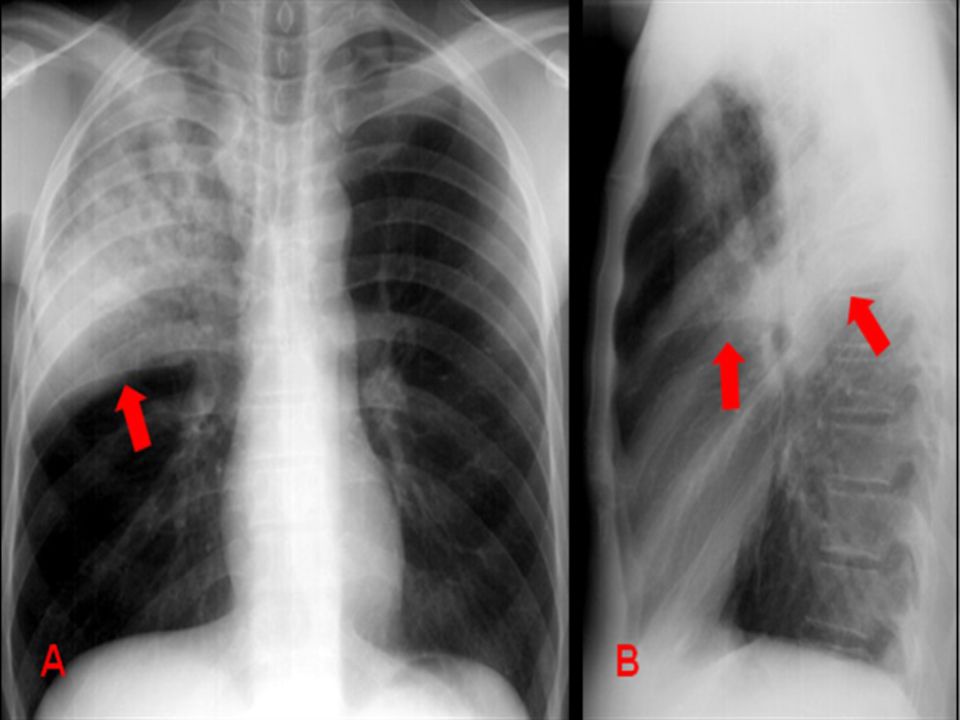 * Radiografias frontal (PA) e perfil mostram consolidação (pneumonia pelo Streptococcus pneumoniae) de lobo superior direito. Observar o limite cissural nítido (setas) e a presença de broncobramas aéreos.