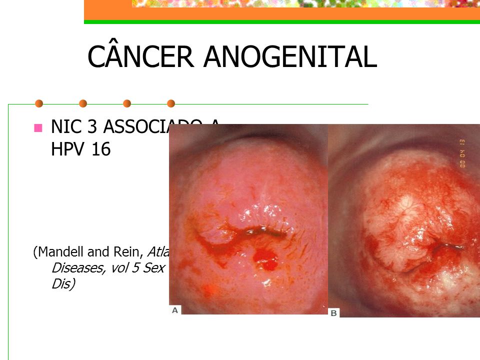 CÂNCER ANOGENITAL NIC 3 ASSOCIADO A HPV 16