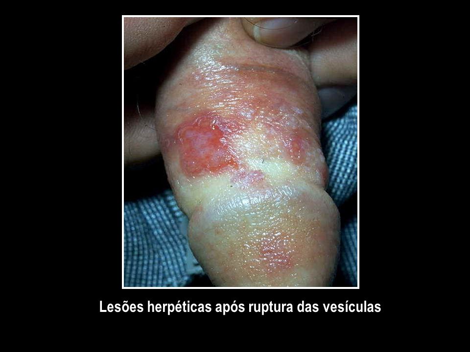 Lesões herpéticas após ruptura das vesículas