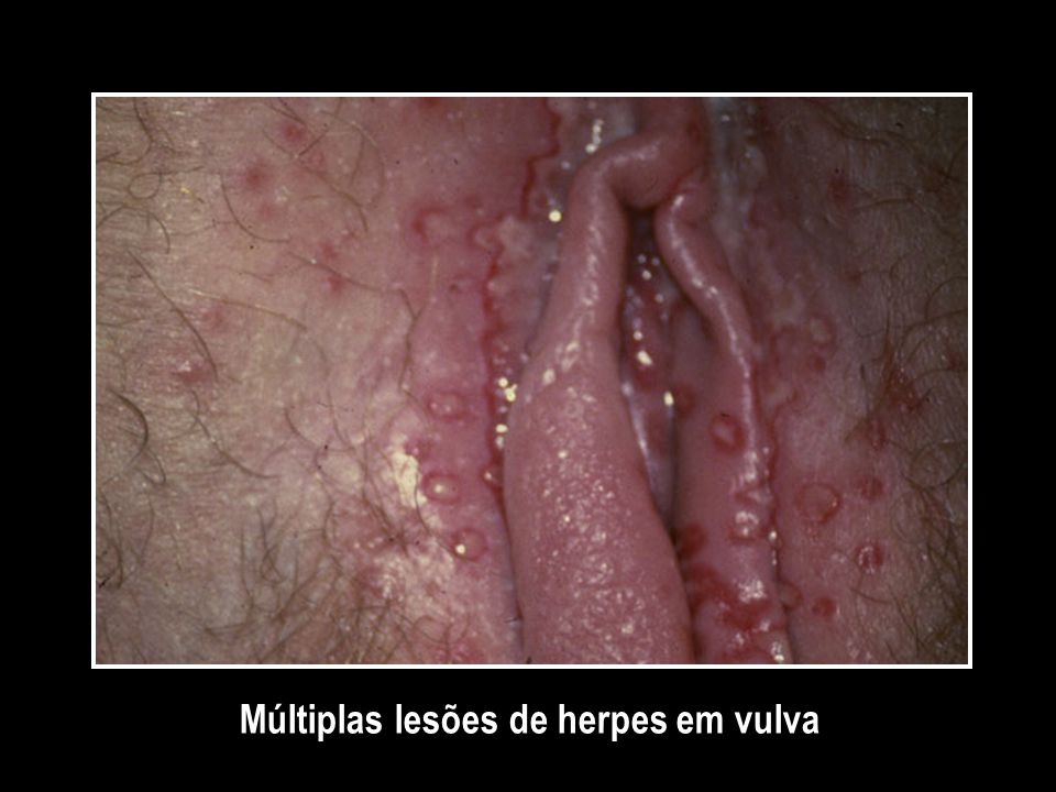 Múltiplas lesões de herpes em vulva