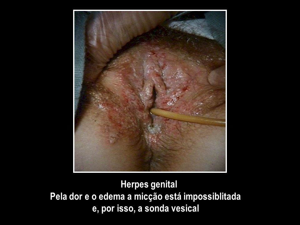Herpes genital Pela dor e o edema a micção está impossiblitada e, por isso, a sonda vesical