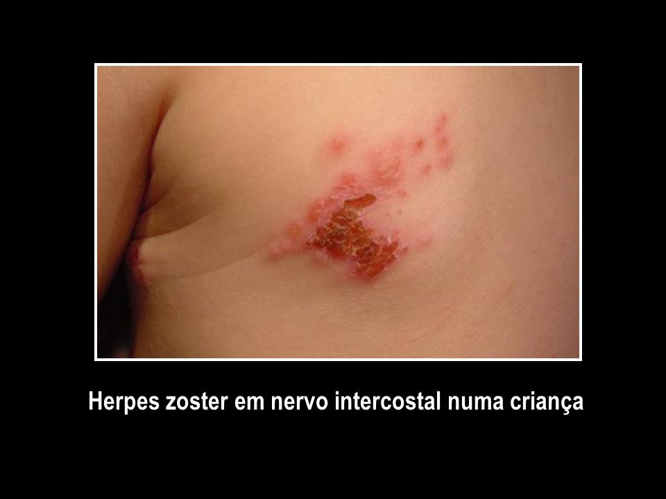 Herpes zoster em nervo intercostal numa criança