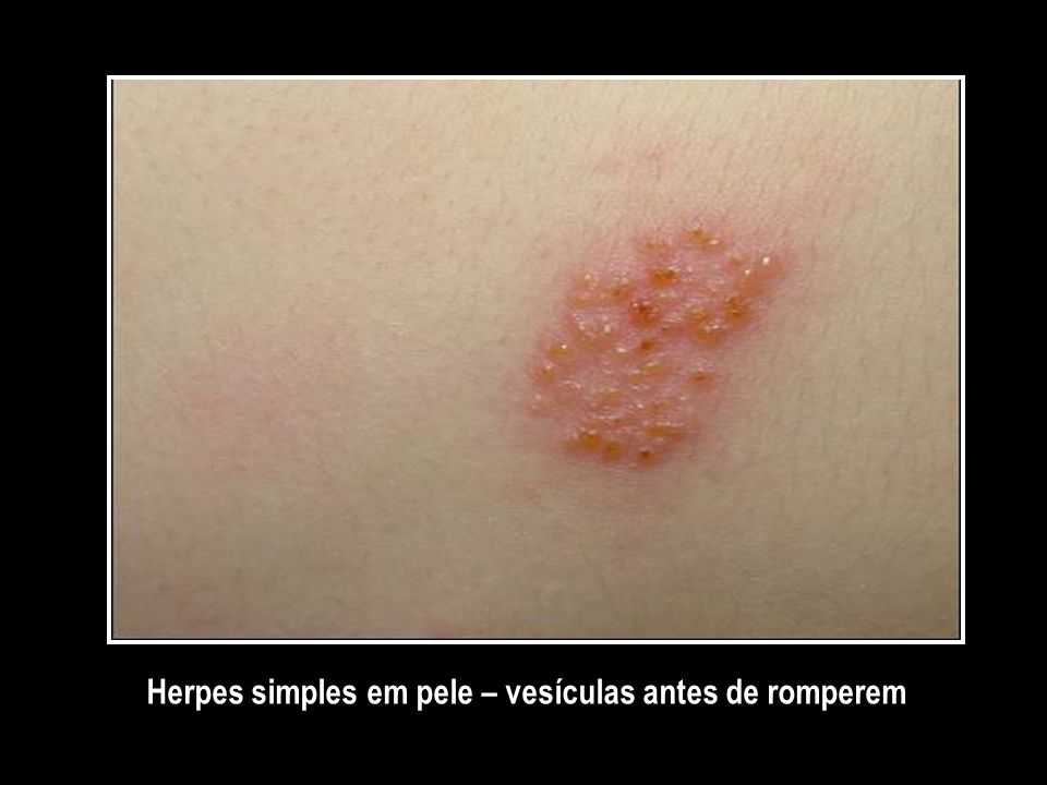 Herpes simples em pele – vesículas antes de romperem