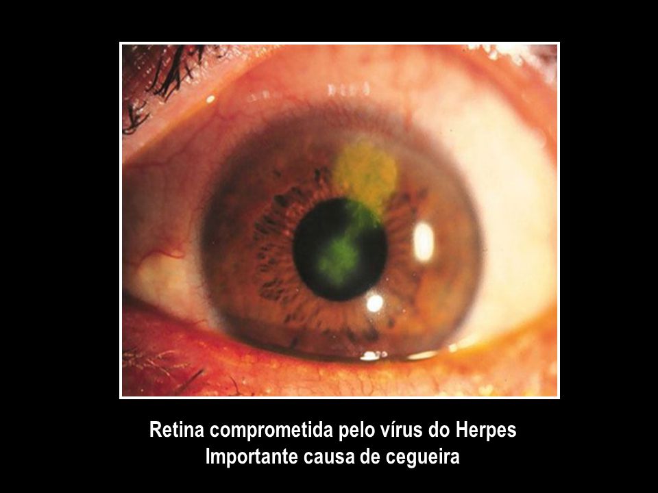 Retina comprometida pelo vírus do Herpes Importante causa de cegueira