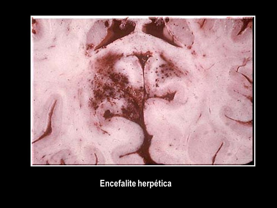 Encefalite herpética
