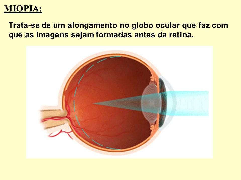 MIOPIA: Trata-se de um alongamento no globo ocular que faz com que as imagens sejam formadas antes da retina.