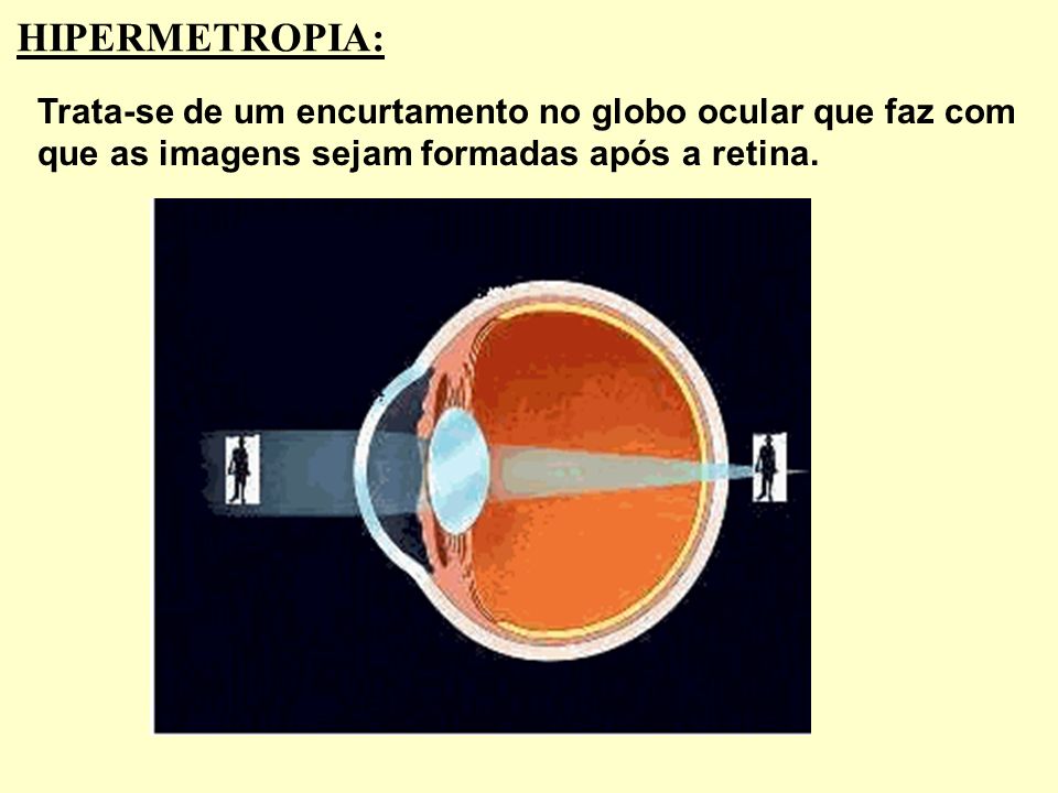 HIPERMETROPIA: Trata-se de um encurtamento no globo ocular que faz com que as imagens sejam formadas após a retina.