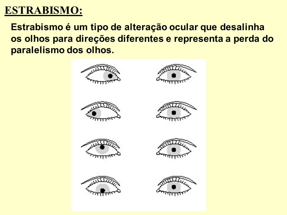 ESTRABISMO: Estrabismo é um tipo de alteração ocular que desalinha os olhos para direções diferentes e representa a perda do paralelismo dos olhos.